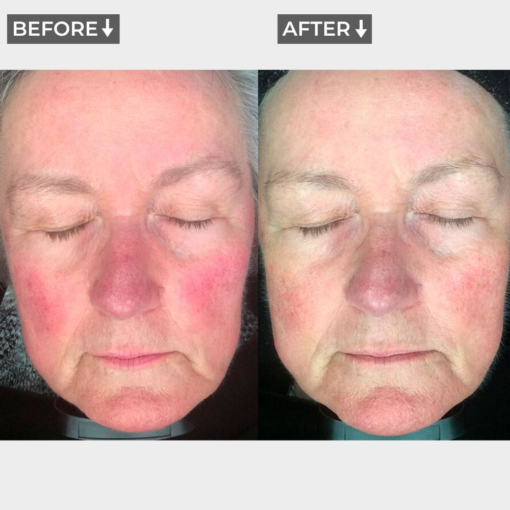 AURA+ Nuvibody® LED-Maske + Dekolleté-Set